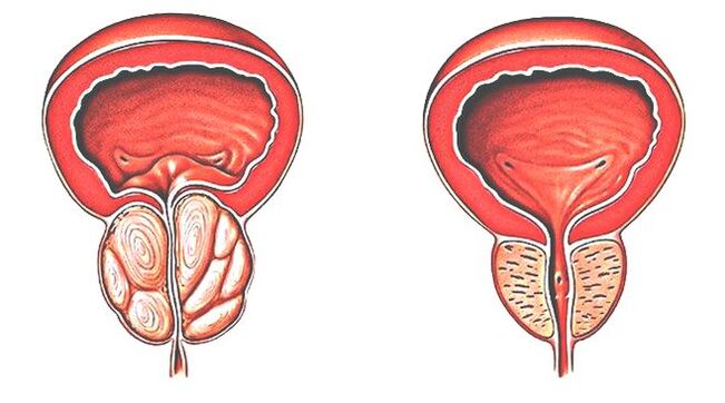 Prostatite e prostata normale