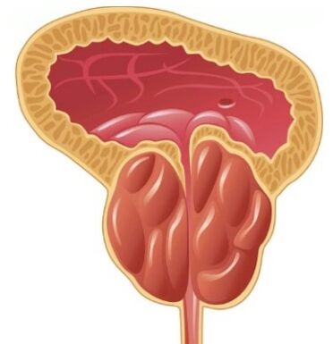 Infiammazione della prostata