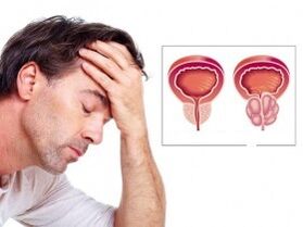 Prostatite in un uomo
