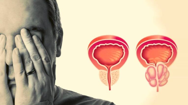 Un uomo ha la prostatite